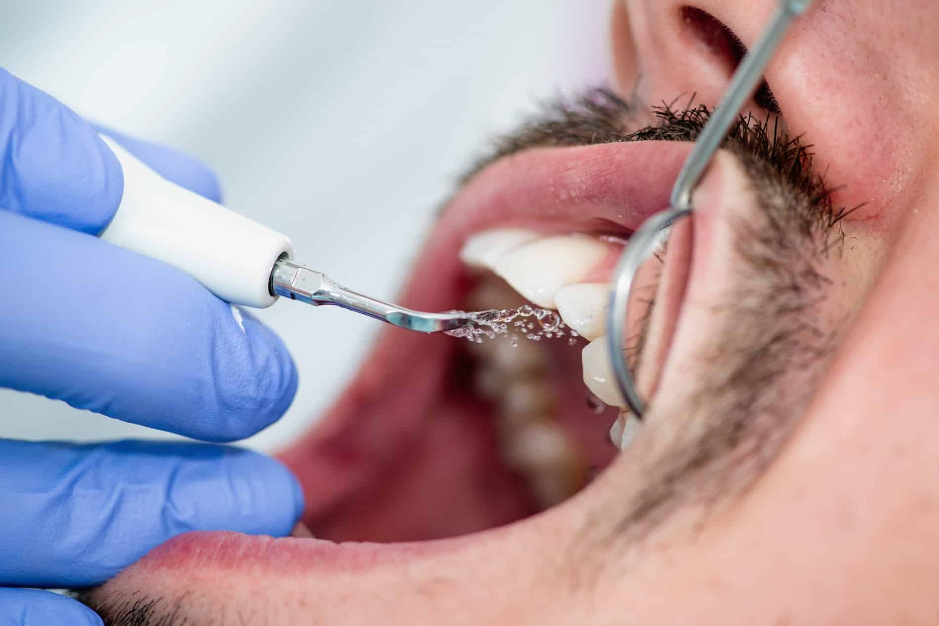 AdobeStock_122619898 v2 Man at his dental cleaning appointment in Des Moines