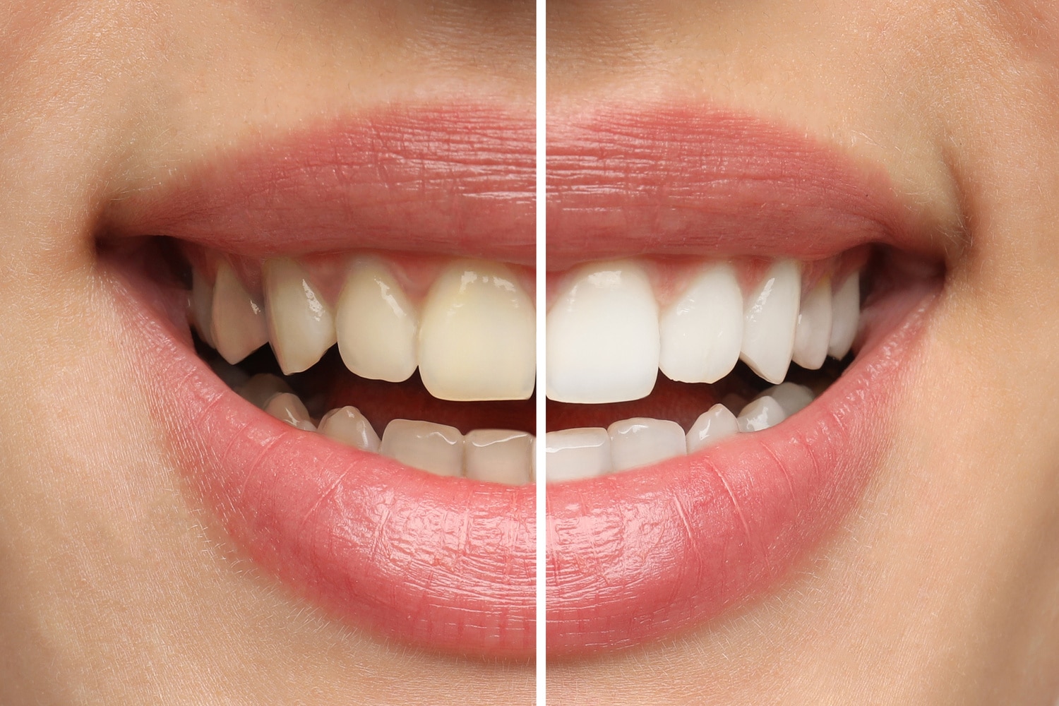 Before and after professional teeth whitening in Des Moines IA