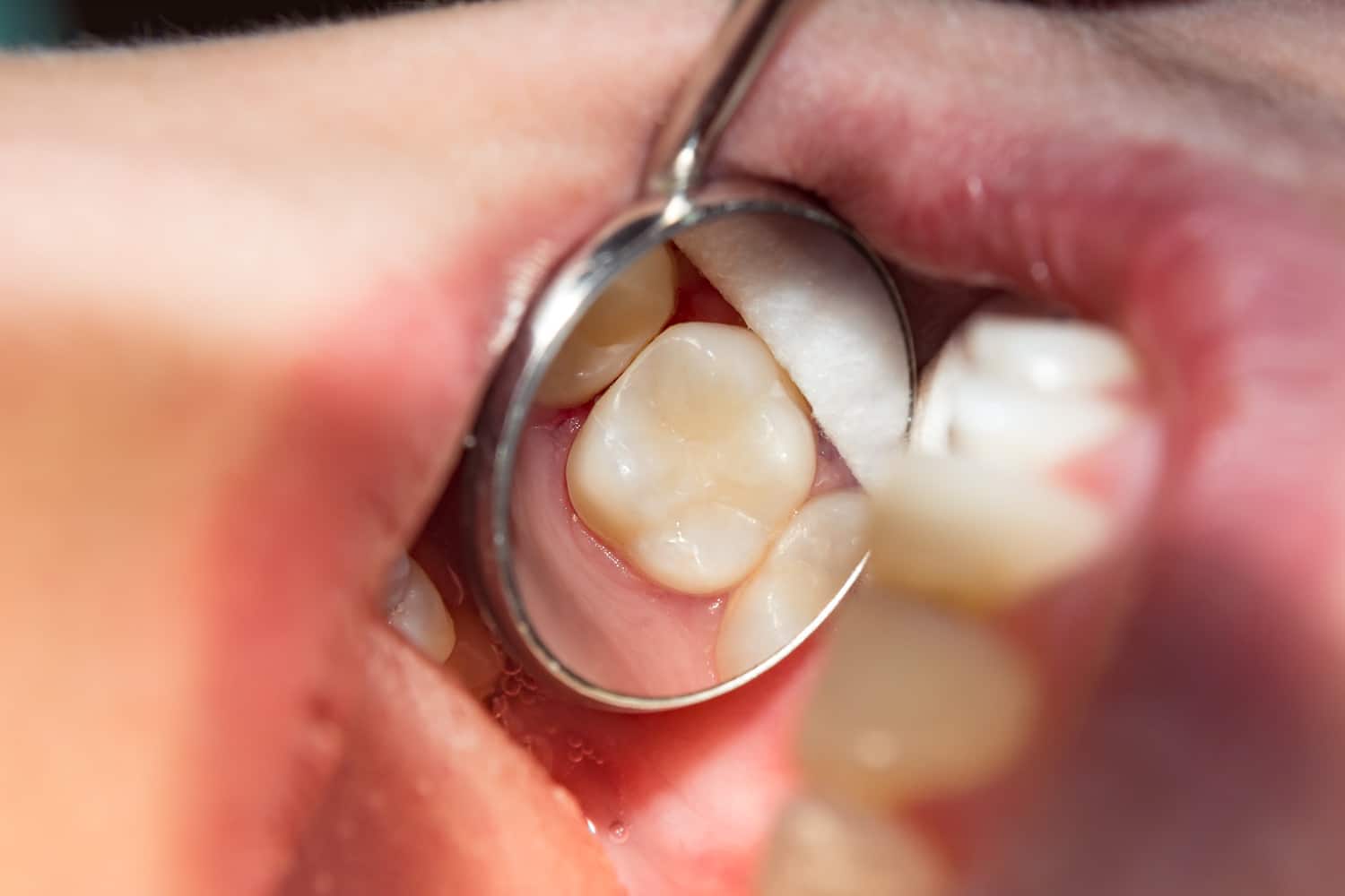 Tooth colored filling at James Dental in Des Moines IA