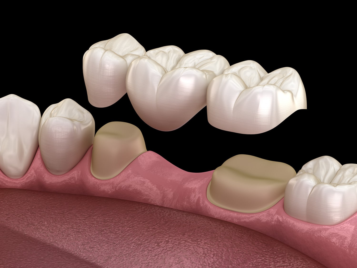 A dental bridge at James Dental in Des Moines IA